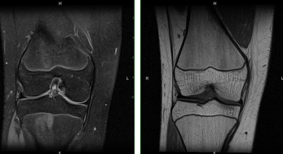 Figure 3 for case Mild alta and early mucoid ACL